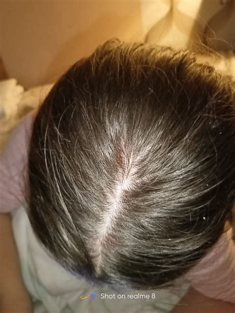 Ilustračná fotografia znázorňujúca začervenané miesta a šupiny na pokožke hlavy