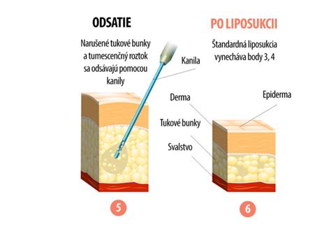Ilustrácia odberu tukového tkaniva pomocou liposukcie s jemnou kanylou
