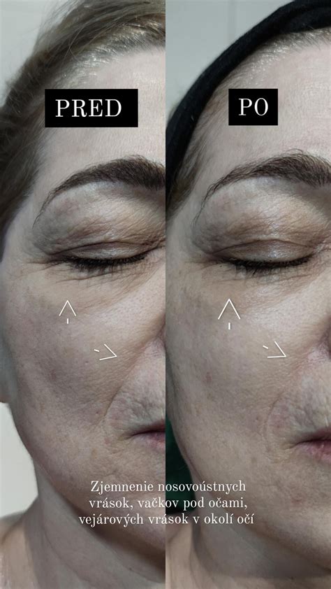 Fotografia klientky pred zákrokom s vyznačenými problematickými partiami tváre