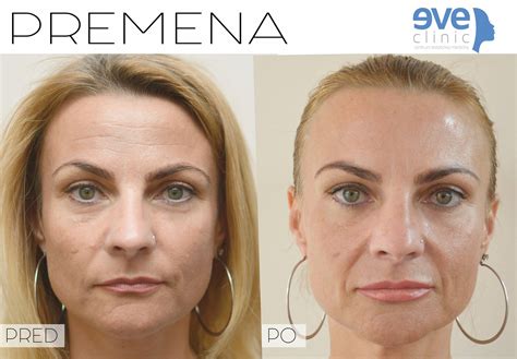 Porovnanie účinkov botulotoxínu a kyseliny hyalurónovej na vrásky