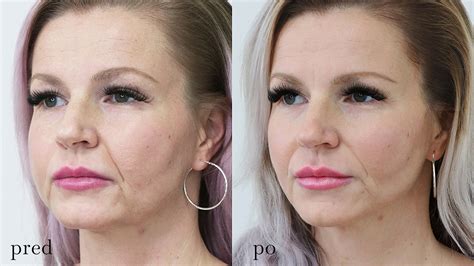 Ilustračná fotografia tváre ženy pred a po aplikácii botulotoxínu, zameraná na vyhladenie vrások na čele a okolo očí.