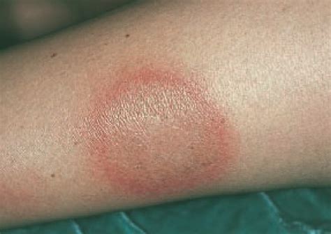 Detailná fotografia typickej kožnej vyrážky erythema migrans s centrálnym vyblednutím.