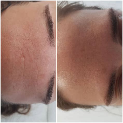 porovnanie pokožky pred a po ošetrení rádiofrekvenciou, s dôrazom na redukciu vrások a spevnenie