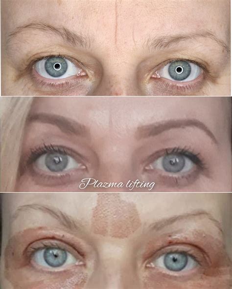 detailné zobrazenie aplikácie ultrazvukového liftingu v oblasti očí