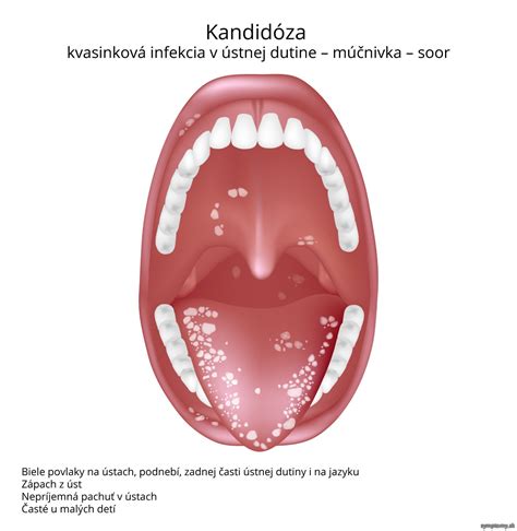 Ilustrácia aftov v ústnej dutine s typickým bielym stredom a červeným okrajom