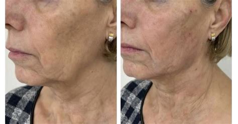 Ilustračná fotografia tváre pred a po laserovom ošetrení CO2 frakčným laserom