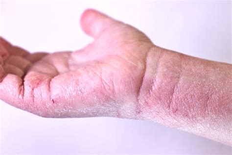 Tabuľka: Potraviny, ktoré môžu zhoršovať atopický ekzém