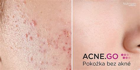 schéma pôsobenia antibakteriálnych zložiek na pokožku s akné