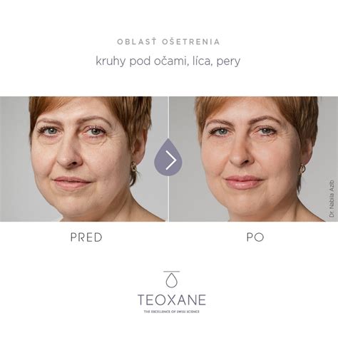 Schéma aplikácie kyseliny hyalurónovej do pier