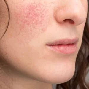 Ilustračné foto rôznych typov pleti a ich problémov, ako začervenanie alebo rosacea.