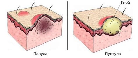 schematické znázornenie tváre s typickými príznakmi rosacey: začervenanie, rozšírené cievky, papuly a pustuly