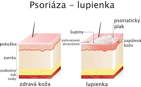Porovnanie zdravej kože a kože postihnutej lupienkou.