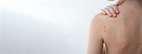 Ilustrácia znázorňujúca vnútorné a vonkajšie faktory spôsobujúce akné na chrbte.