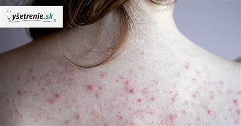 Infografika s tipmi na prevenciu akné na chrbte.