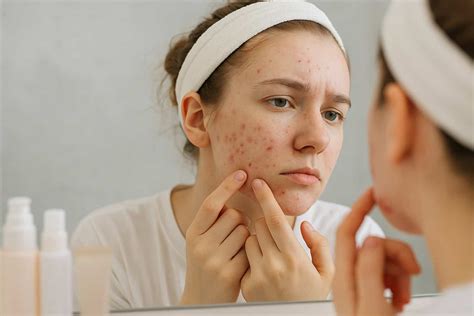 Ilustrácia znázorňujúca rôzne typy akné a ich príčiny