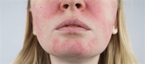 Ilustrácia tváre s viditeľnými kapilárami (kuperóza)