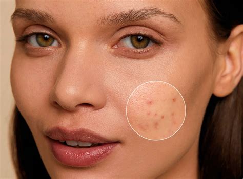 Infografika: Účinné zložky v starostlivosti o pleť s akné