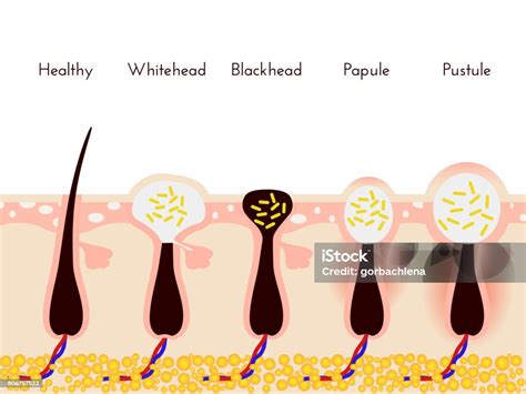 Ilustrácia rôznych typov akné - čierne bodky, biele bodky, papuly, pustuly
