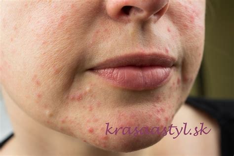 detailný záber pokožky tváre s viditeľnými popraskanými žilkami v okolí nosa a na lícach