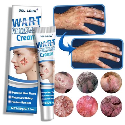 Ilustrácia rôznych typov liečby rosacey: lokálny krém, tabletky, laserové ošetrenie.