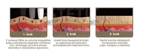 Ilustrácia hĺbky prieniku ultrazvuku pri HIFU ošetrení