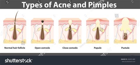 Ilustrácia znázorňujúca rôzne typy akné a ich prejavy