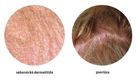 Ilustrácia porovnávajúca seboreu a psoriázu