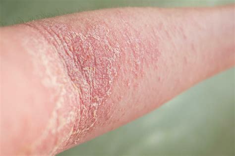 obrázok zobrazujúci rôzne štádiá xerodermie na koži