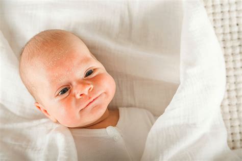 Ilustračná fotografia dieťaťa s atopickým ekzémom na tvári