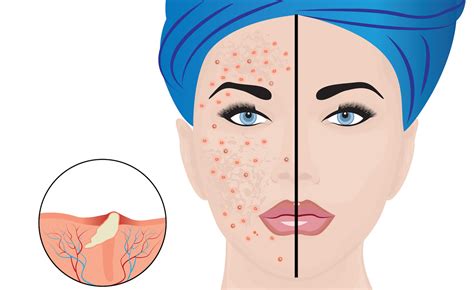 Koláž z rôznych komentárov a hodnotení zinkovej masti na akné.