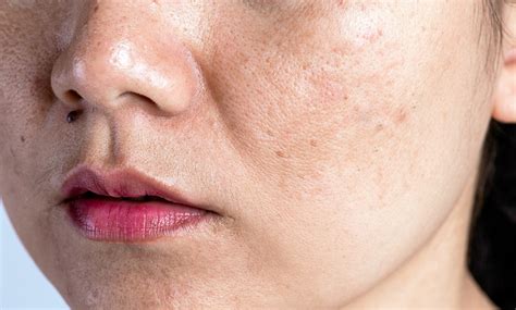 Ilustračná fotografia pokožky s viditeľnými pórmi a nedokonalosťami