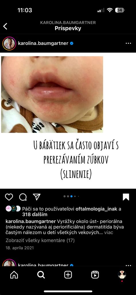 Ilustrácia tváre s vyrážkou typickou pre periorálnu dermatitídu okolo úst