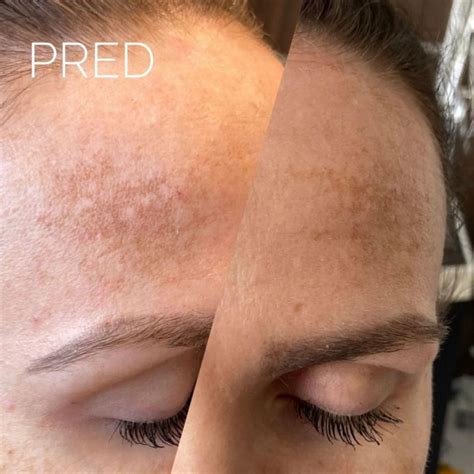 porovnávacia fotografia pred a po laserovej liečbe pigmentových škvŕn