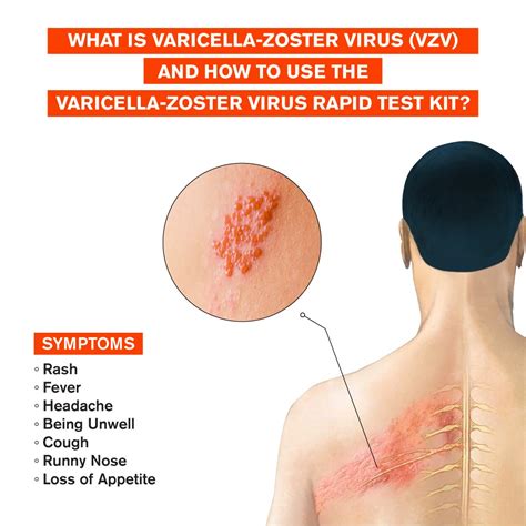 Ilustrácia vírusu Varicella Zoster