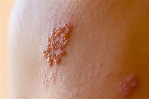 Kožný výsev pásového oparu na trupe