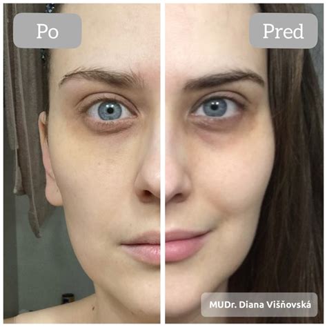 Porovnanie pred a po aplikácii výplní kyselinou hyalurónovou