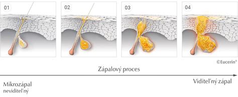 Schéma vzniku akné - upchatý pór