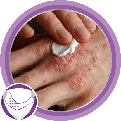 Ilustrácia pokožky s ekzémom