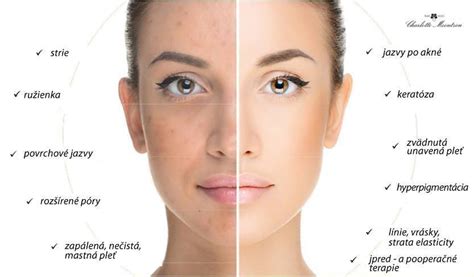 rozličné typy kyselín pre chemický peeling