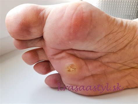 Ilustrácia zobrazujúca rôzne štádia suchej a popraskanej pokožky na chodidlách, od mierneho olupovania po hlboké trhliny.