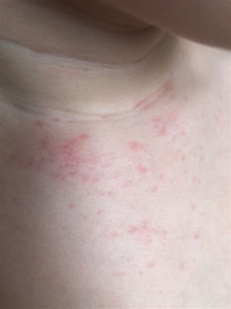 Infografika porovnávajúca atopický ekzém a alergiu