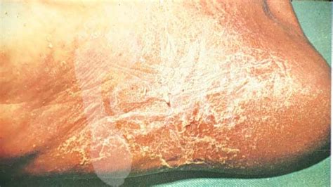 Detailný záber na pokožku medzi prstami nohy s príznakmi mykózy - olupovanie, začervenanie.