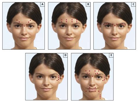Vizualizácia oblastí tváre, kde sa najčastejšie aplikuje botox.
