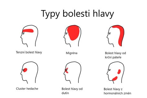 Ilustračná schéma tváre s vyznačenými oblasťami aplikácie botoxu a možnými bodmi bolesti hlavy