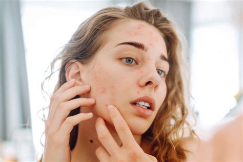 Ilustrácia rôznych typov vyrážok pri akné