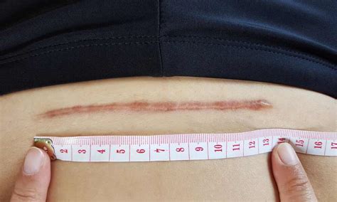 žena jemne masíruje jazvu po cisárskom reze