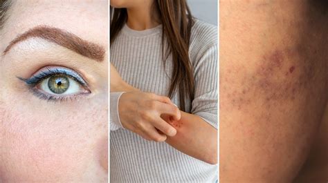 Ilustrácia znázorňujúca nepravidelné škvrny na koži ako príznak kožnej mykózy.