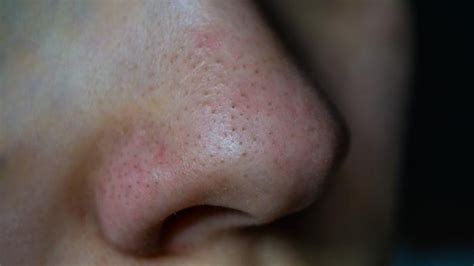 Ilustrácia zobrazujúca rôzne typy akné (biele bodky, čierne bodky, bolestivé vyrážky)