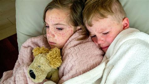 Obrázok znázorňujúci šírenie vírusových ochorení ako osýpky