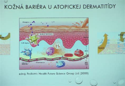 Ilustrácia tváre s viditeľnými príznakmi atopickej dermatitídy - začervenanie a suché flaky